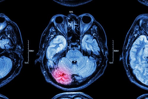 MRI image of brain injury