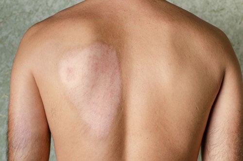 Man's back with healed scar from second-degree burn